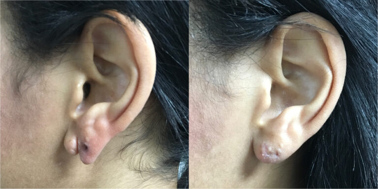 earlobe repair manchester