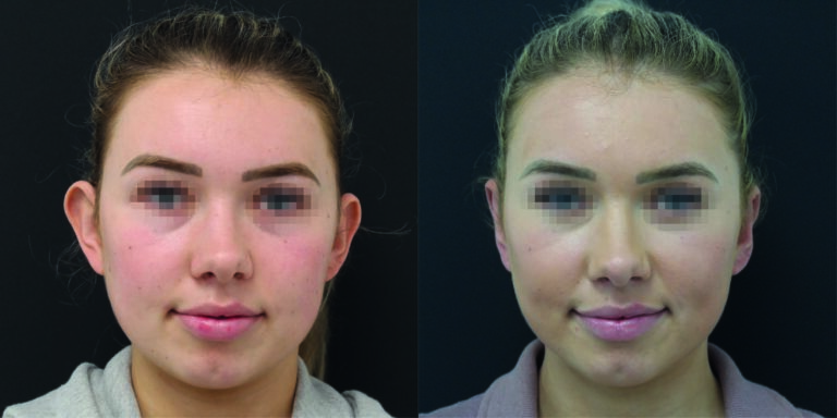 pinnaplasty before and after
