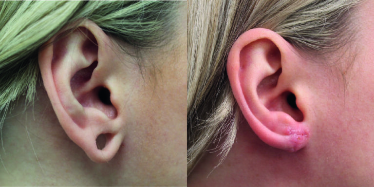 stretchedearloberepair1