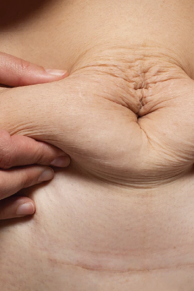 abdominoplasty-manchester