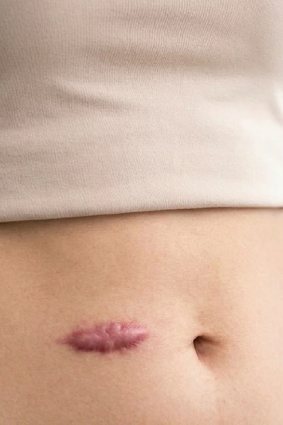 keloid-scar-treatment