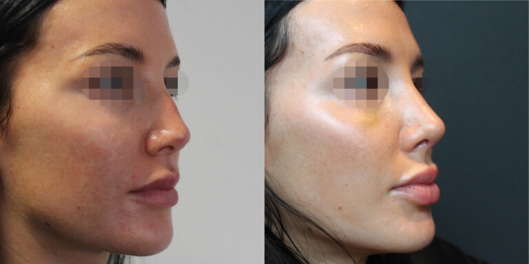 rhinoplasty before and after