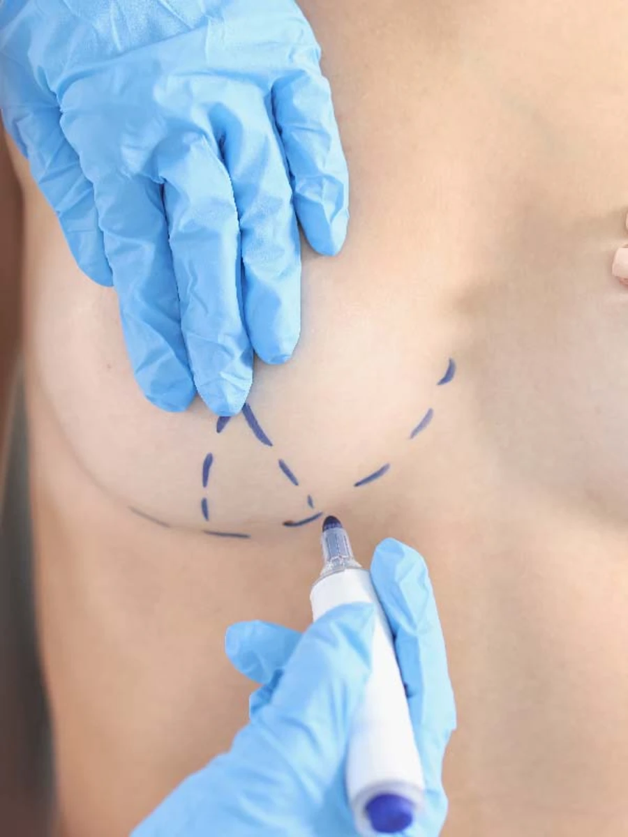 Breast uplift results at Deansgate Hospital Manchester